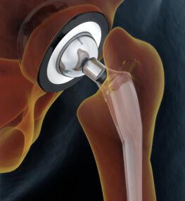 Эндопротезирование