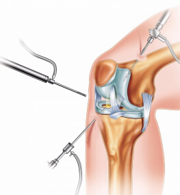 Артроскопия